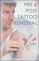 Tattoo Removal - Treatment Instructions