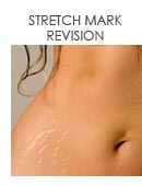 Stretch Mark Revision