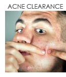 Acne Clearance